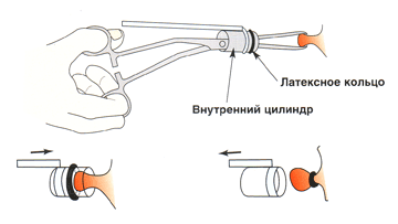 Лечение геморроя латексными кольцами (rubber band ligation) - Клиники Беларуси